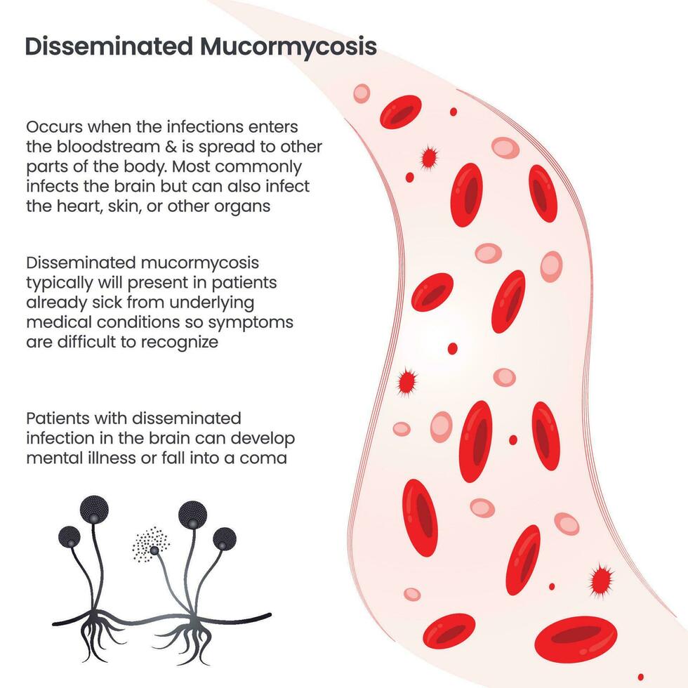 Disseminated Mucormycosis vector illustration informational graphic