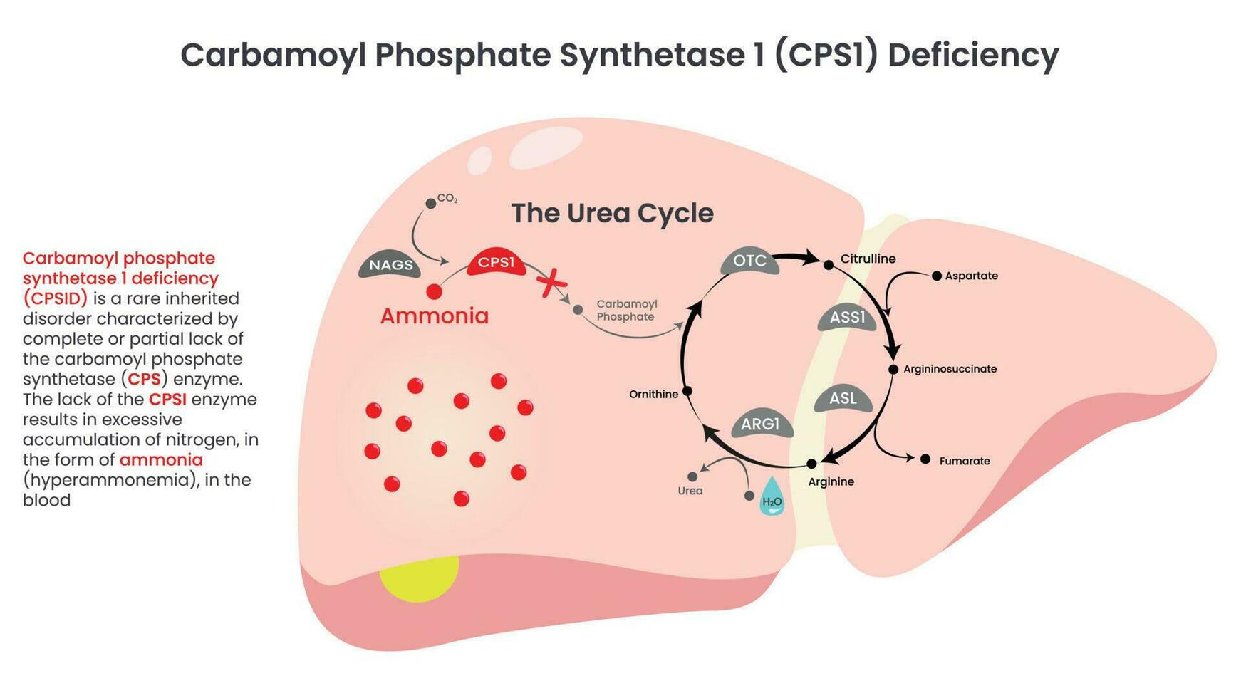 Carbamoyl Phosphate Synthetase CPS1 Deficiency vector illustration