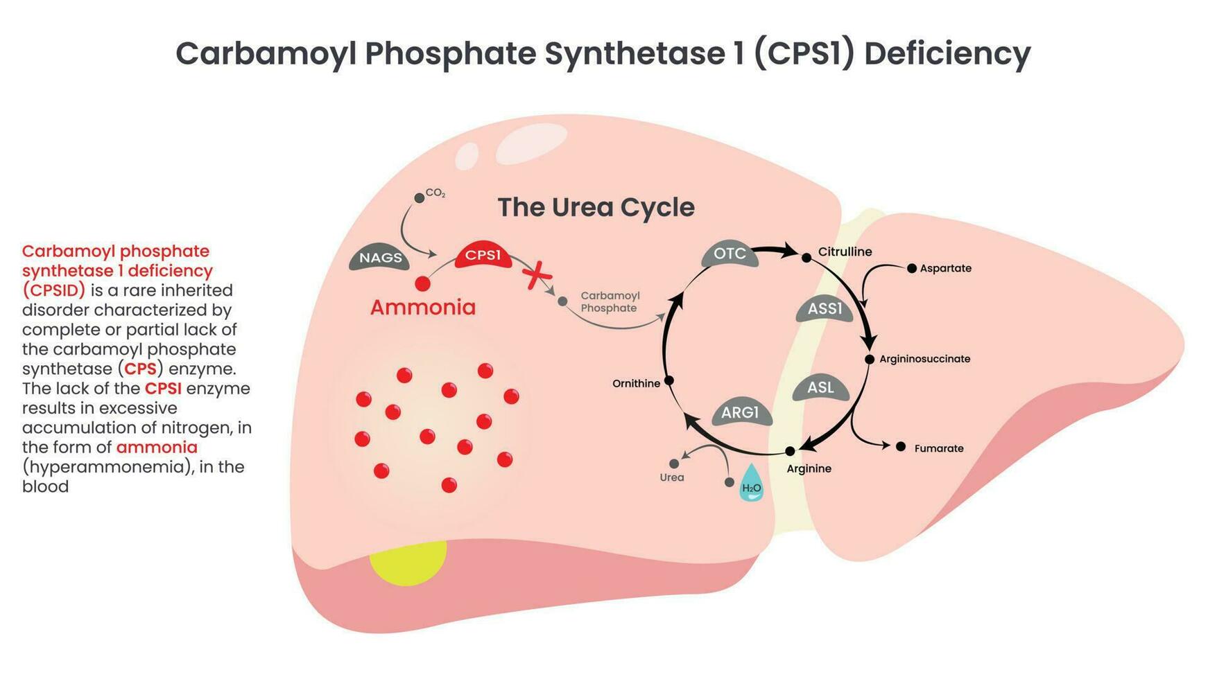 Ilustración de vector de deficiencia de carbamoil fosfato sintetasa cps1