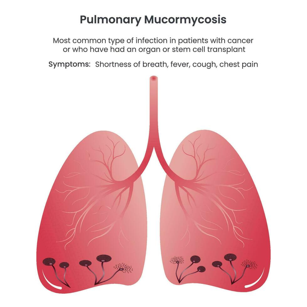 Pulmonary Mucormycosis vector illustration informational graphic