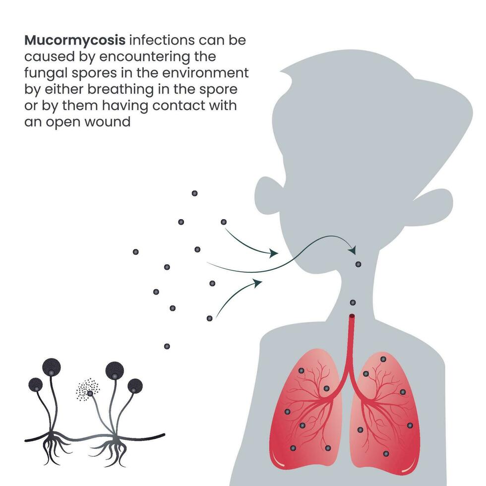 Mucormycosis black fungus infection in the lungs through inhaled spores vector