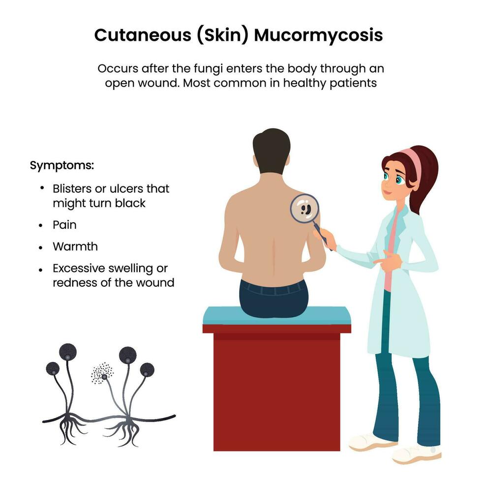 mucormicosis cutánea ilustración vectorial gráfico informativo vector