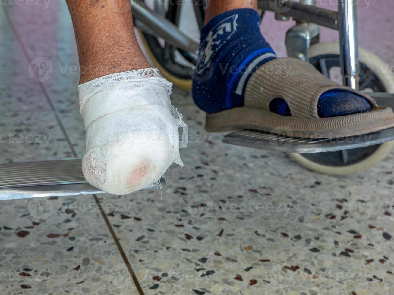 infección del pie diabético, paciente dm tiene herida en el arco del pie e infección crónica foto