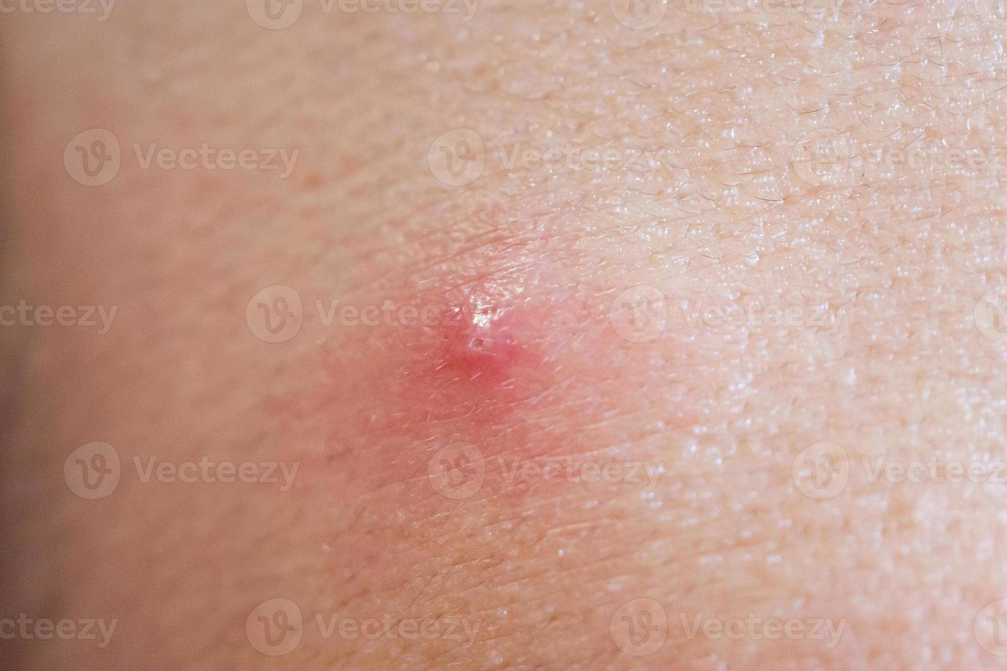 Inflammatory acne with red spot on face closeup photo