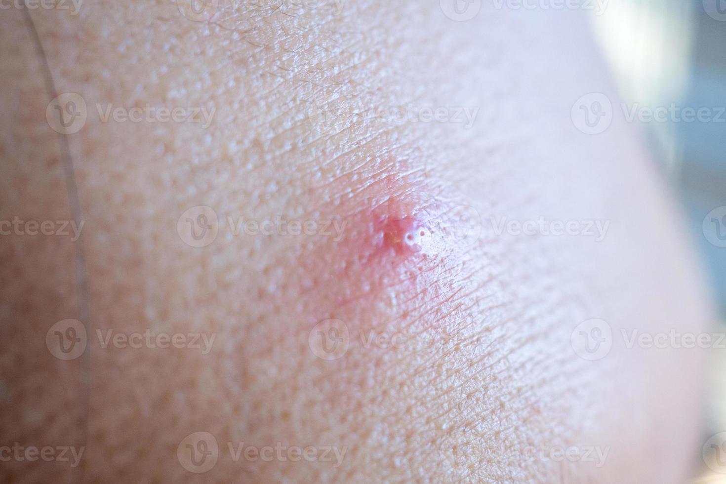 Inflammatory acne with red spot on face closeup photo