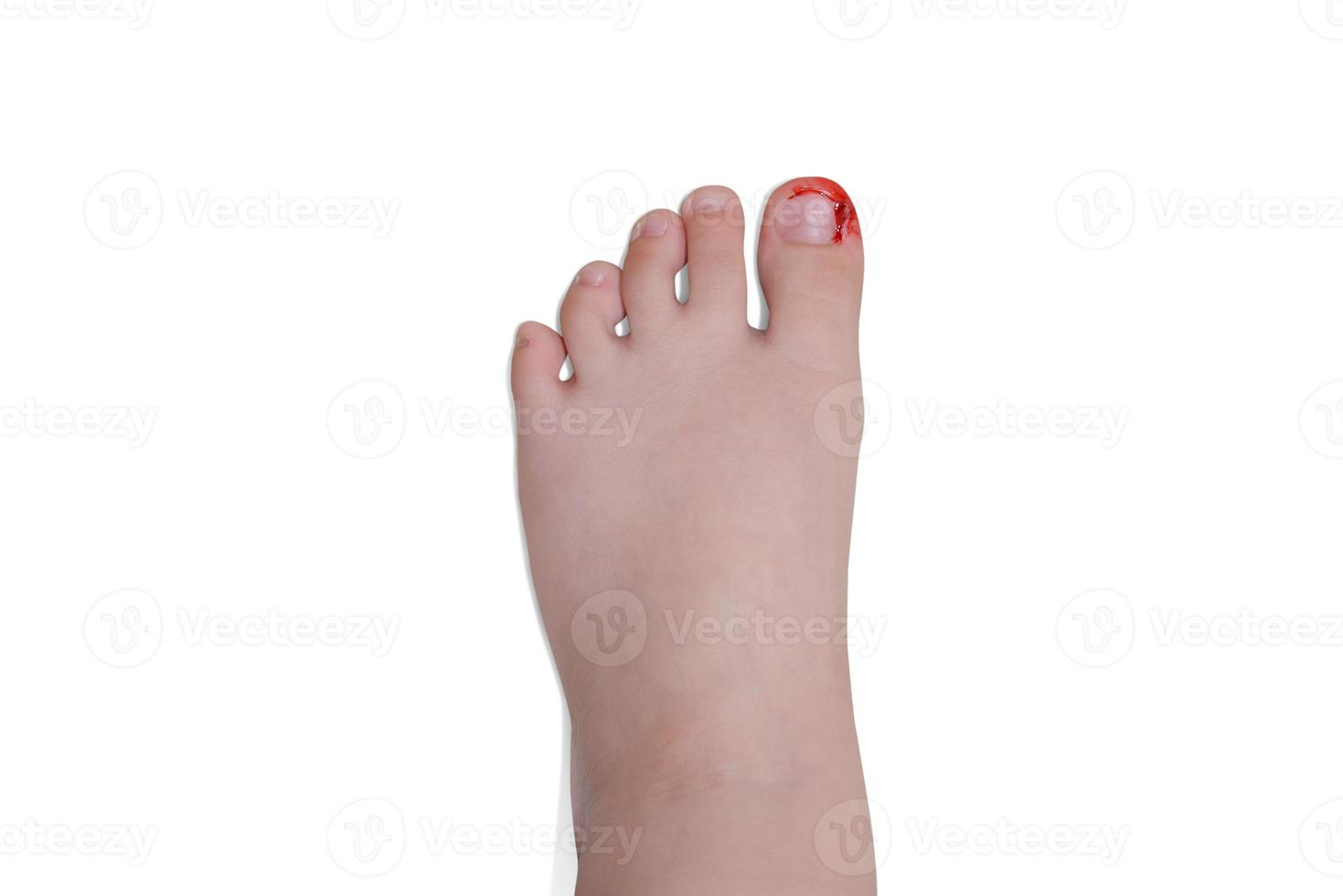 Bleeding wound on toe, isolated on white. concept of pain photo