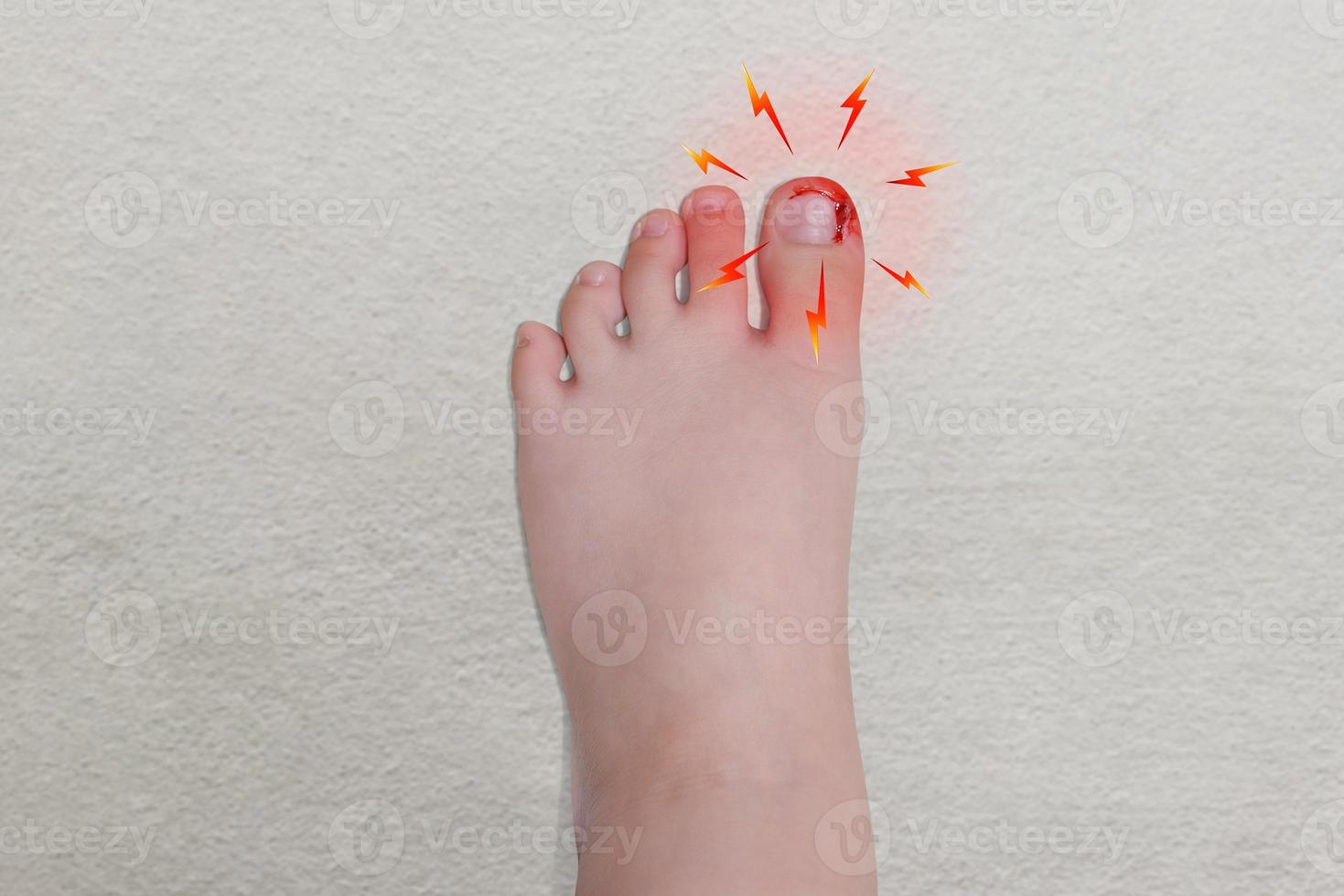 Bleeding wound on toe, isolated on white. concept of pain photo