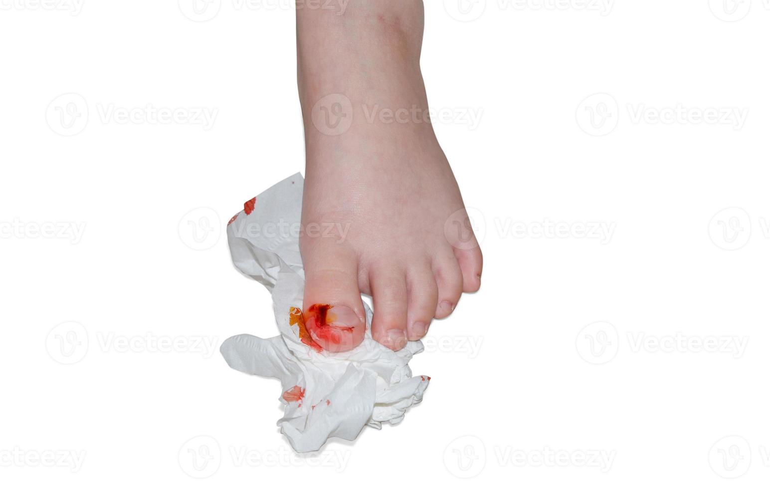 herida sangrante en el dedo del pie, aislada en blanco. concepto de dolor foto