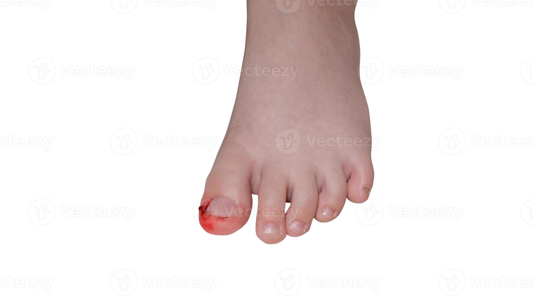 Bleeding wound on toe, isolated on white. concept of pain photo