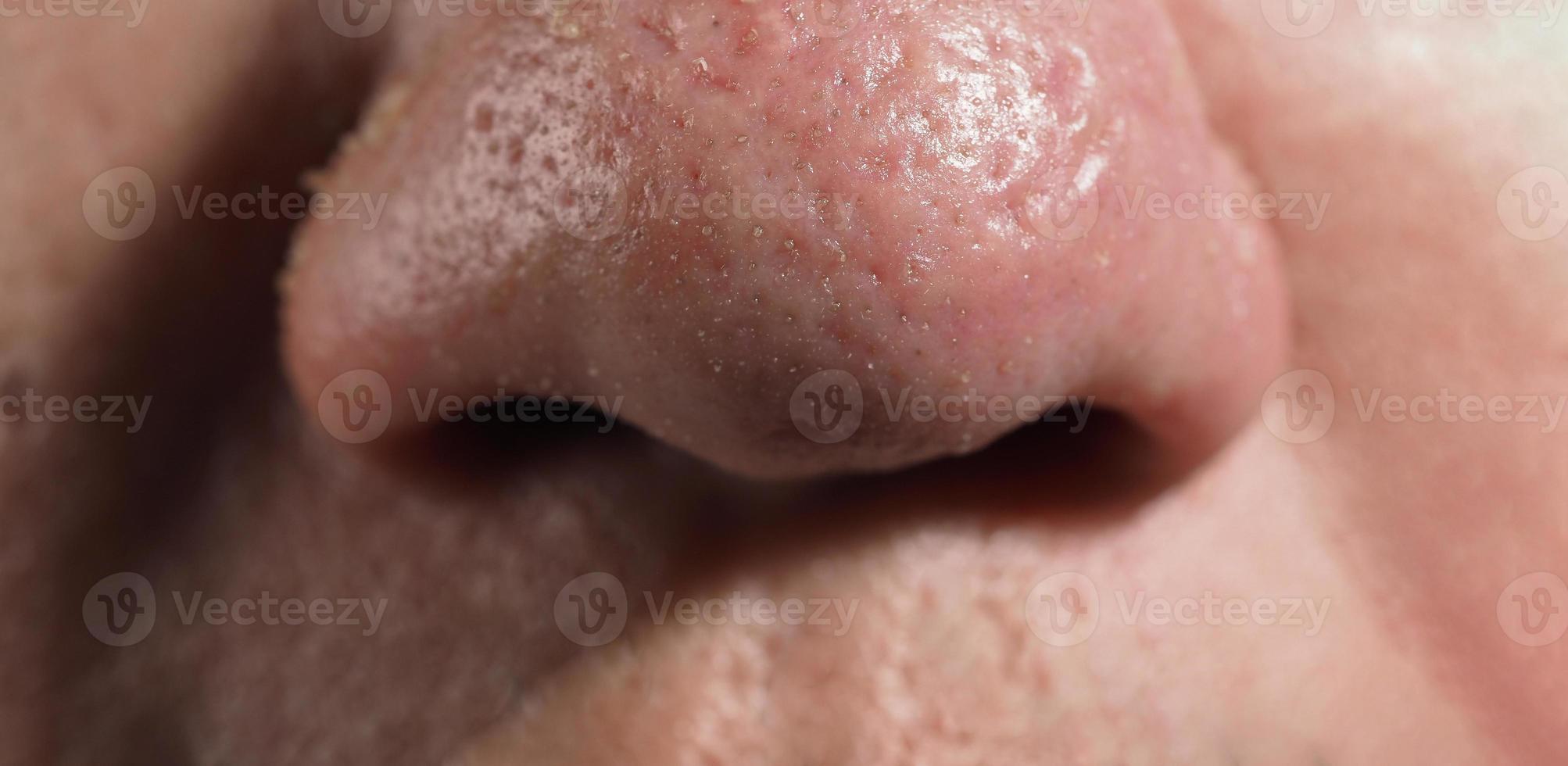 Acne and problem pores. White and blackhead pimples from nose pores. photo