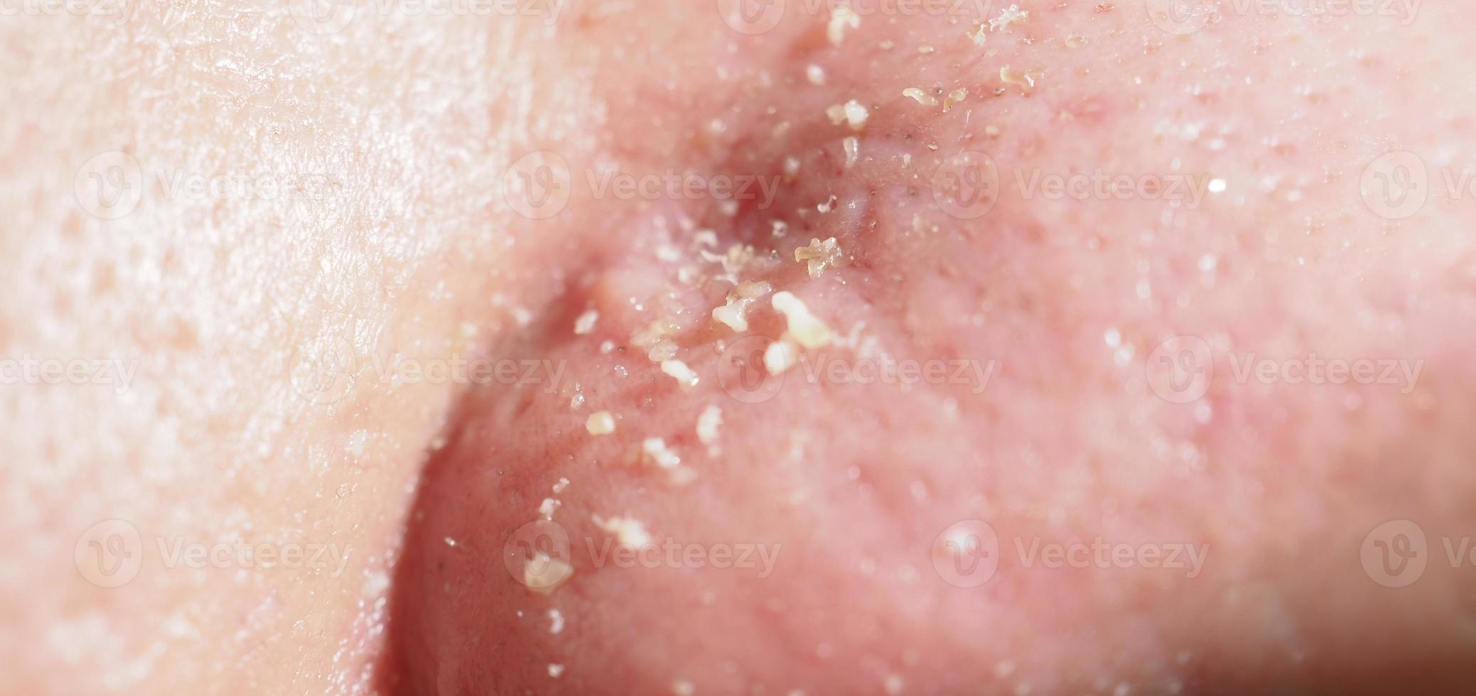 Acne and problem pores. White and blackhead pimples from nose pores. photo