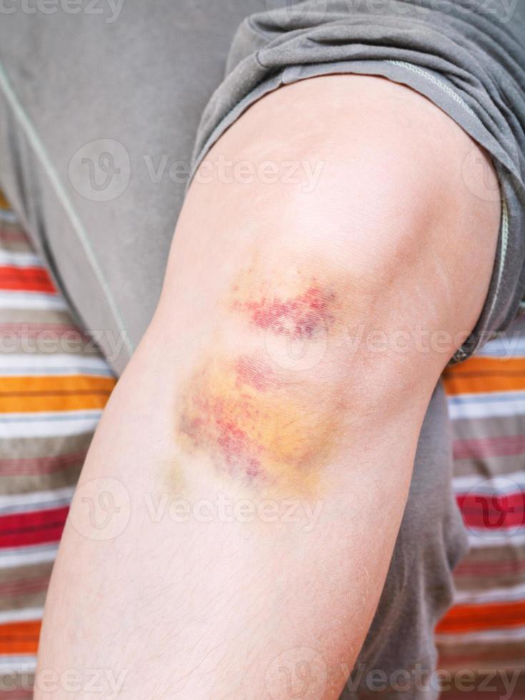 knee injury - bruise on leg photo