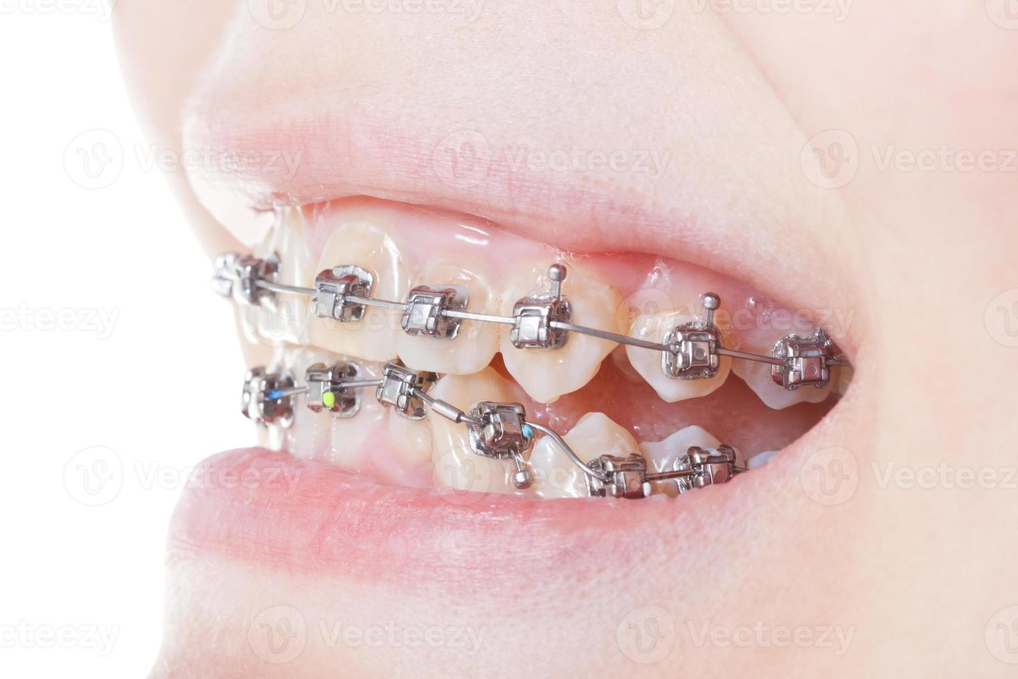 side view of dental braces on teeth close up photo