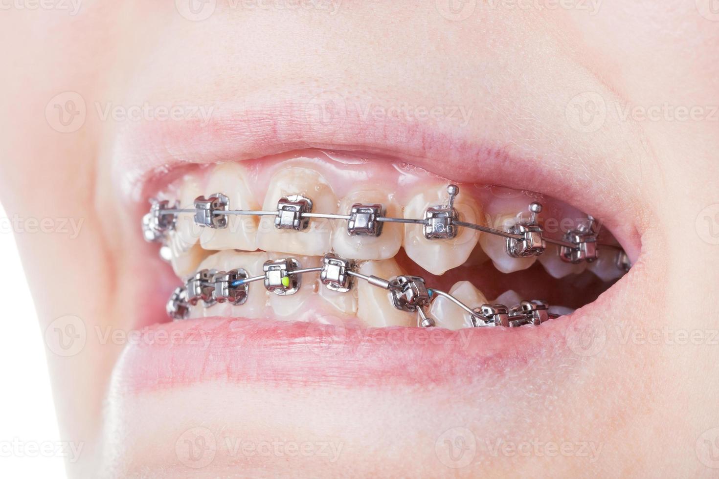 dental steel brackets on teeth close up photo