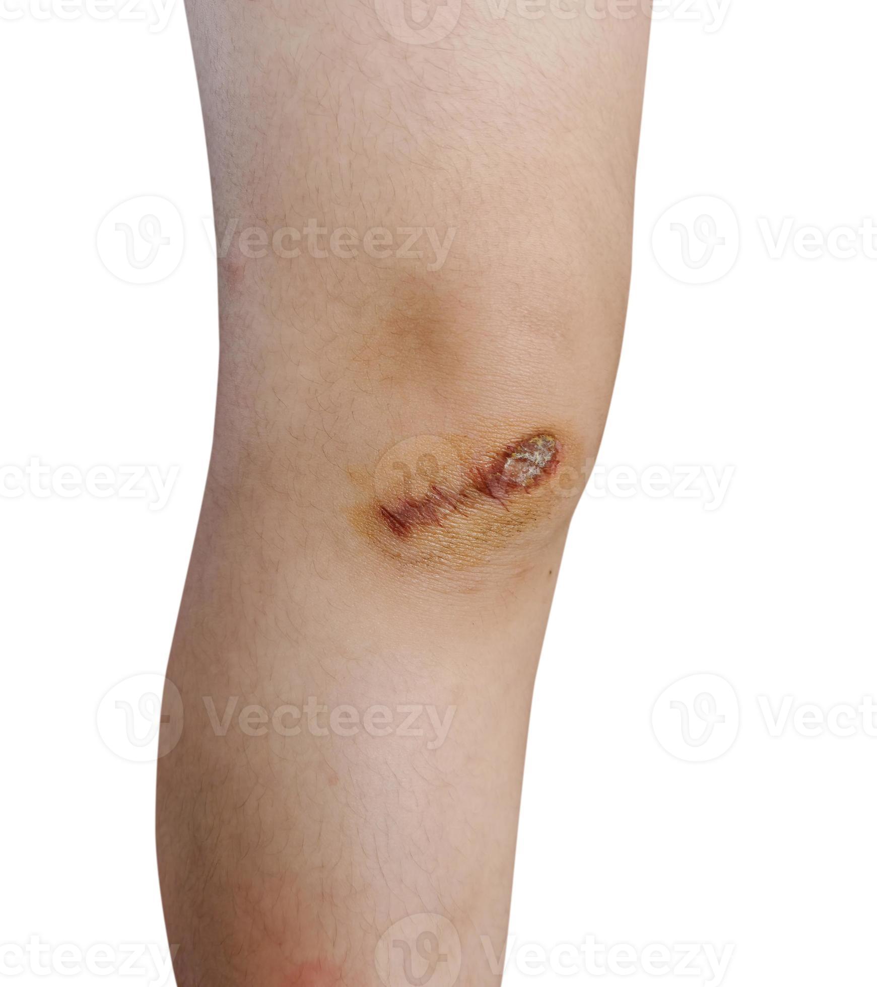 Scar and scab eschar on the knee 11870527 Stock Photo at Vecteezy