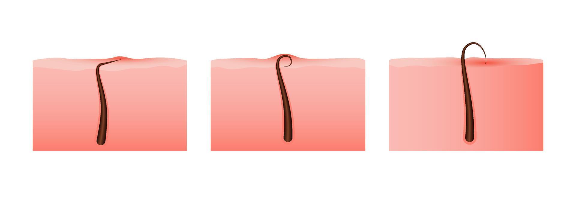 Hair growth cycle. Scheme of hair follicle with development from skin vector