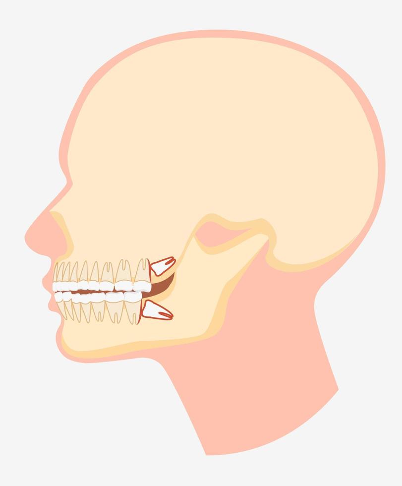 Cartoon model of human dental jaw side view vector flat illustration. Skull image with wisdom tooth pushing adjacent teeth isolated on white background. Dentistry surgery problem