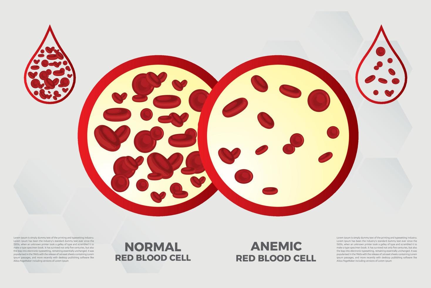 anemia hierro glóbulos rojos medical vector ilustración médica.