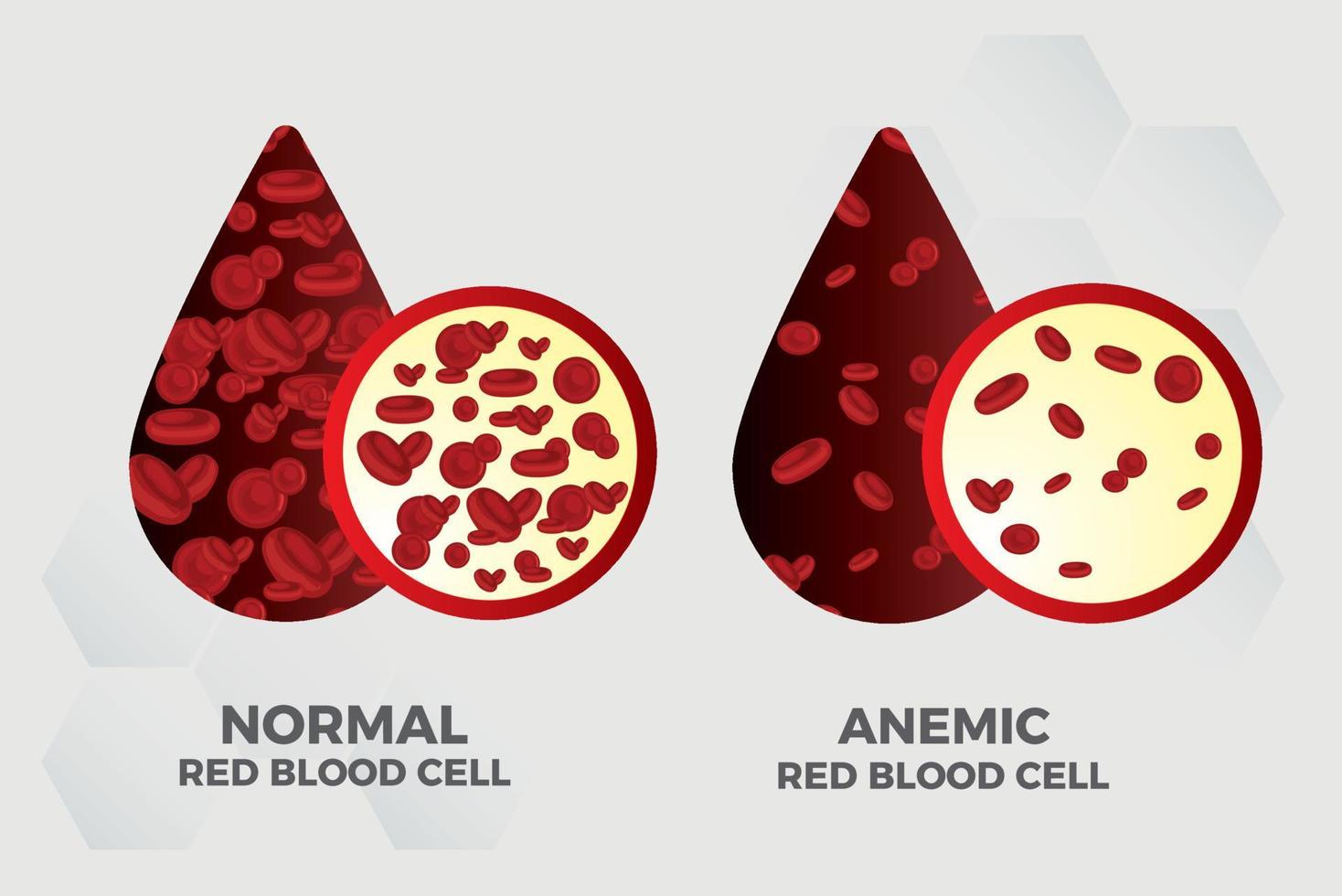 anemia hierro glóbulos rojos medical vector ilustración médica.