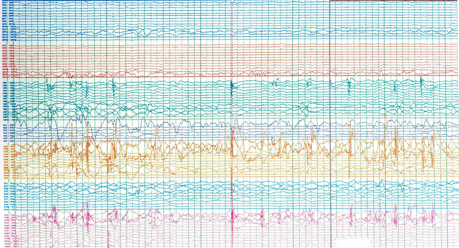 Photography of brain waves  of epileptic patient showing sharp wave during  no seizure or interictal EEG. photo