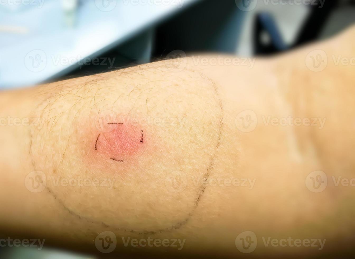 Mantoux vaccination, Closeup view photography of patient arm with red spot reaction to conducting Mantoux test. Positive tuberculocis patient. photo