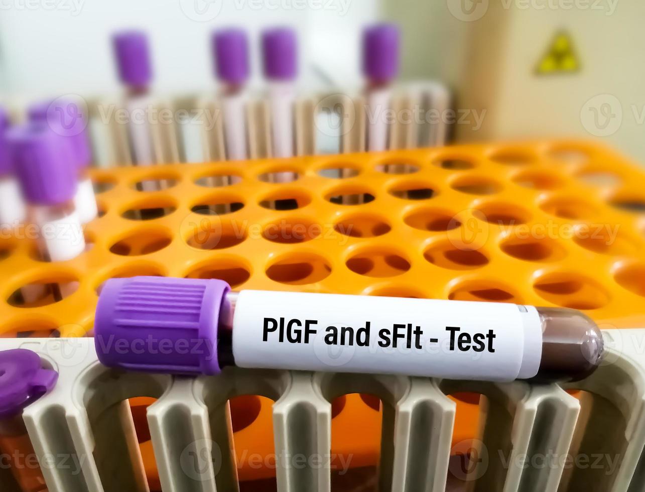 Blood sample for placental growth factor or PIGF and Soluble fms like tyrosine kinase or sFLT test in laboratory. photo