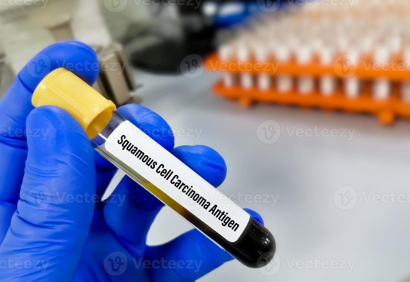 antígeno de carcinoma de células escamosas o prueba scca para el diagnóstico de carcinoma de células escamosas. marcador tumoral para el cáncer de células escamosas. foto