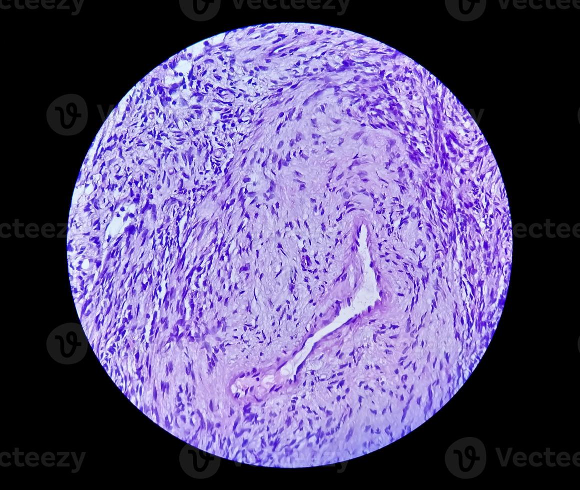 Photomicrograph of a schwannoma, a benign soft tissue tumor of peripheral nerve sheath. photo