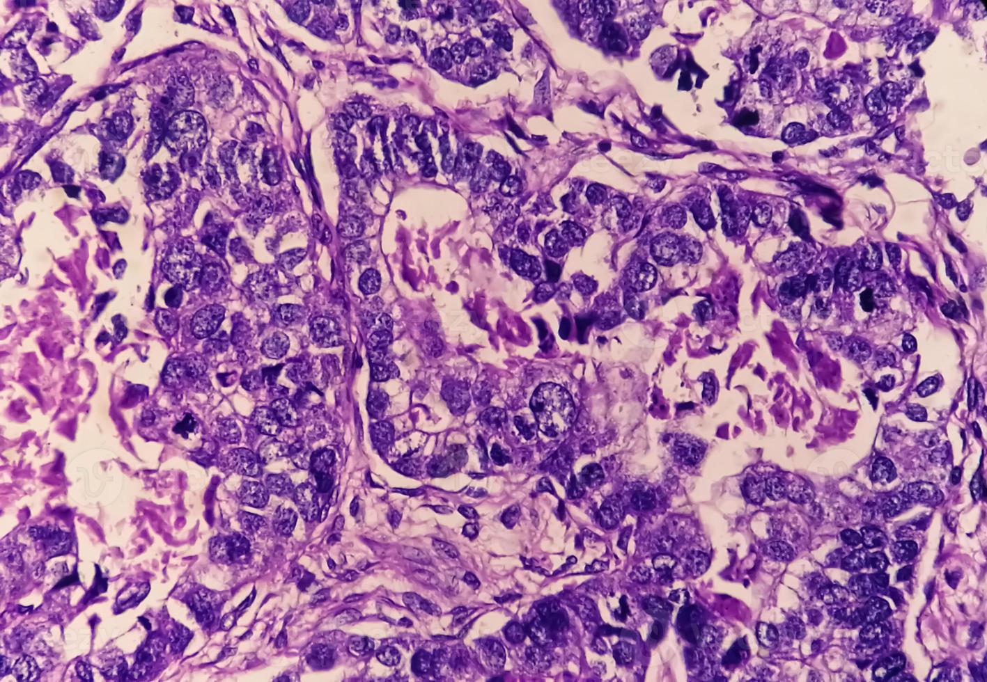 Photomicrograph or microscopic image of Stomach cancer. Adenocarcinoma of stomach photo