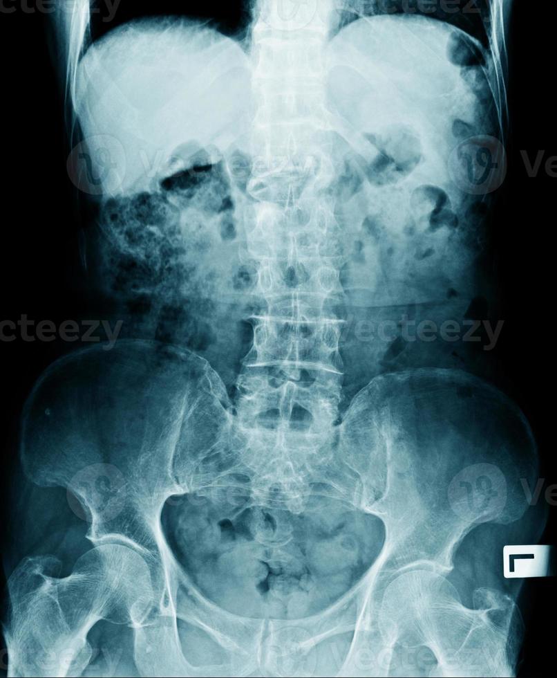 x-ray image of lumbo sacral photo