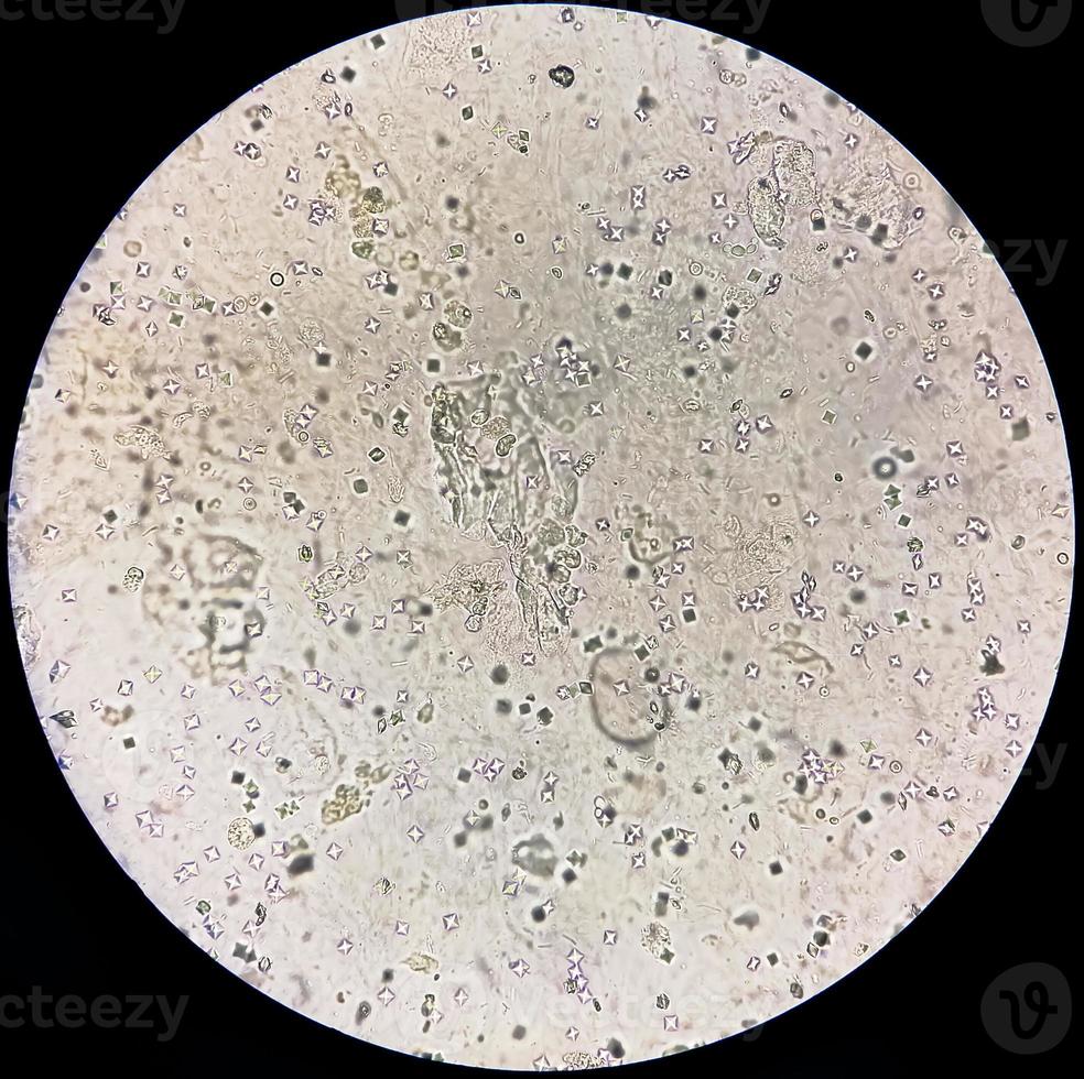 Microscopic image showing Calcium oxalate crystal and others urinary crystals from urine sediment. photo