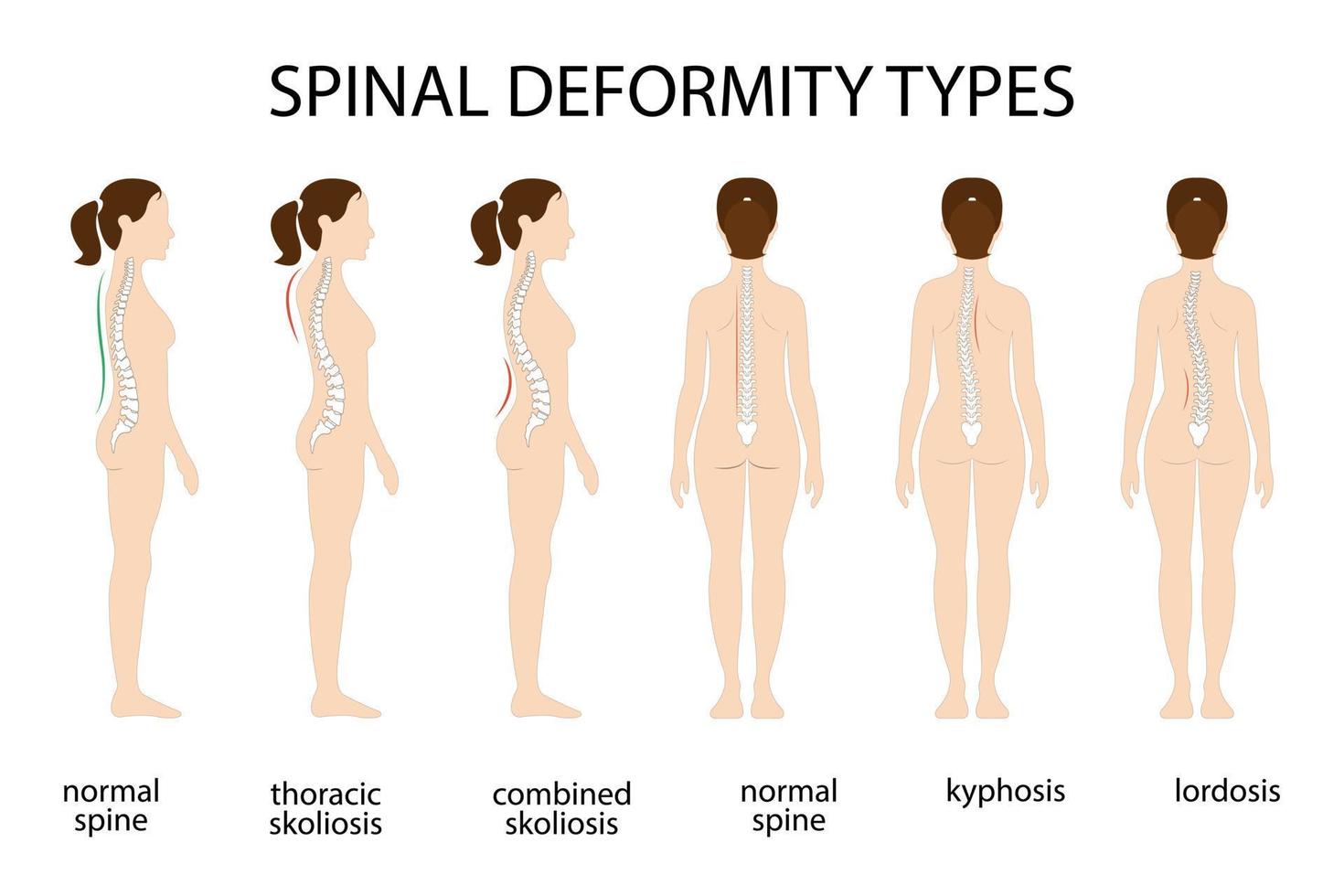 Tipos de deformación de la columna vertebral y afiche de diagrama de comparación de la columna vertebral saludable con curvaturas de la columna vertebral. perfil femenino y vista posterior. información quiropráctica. vector