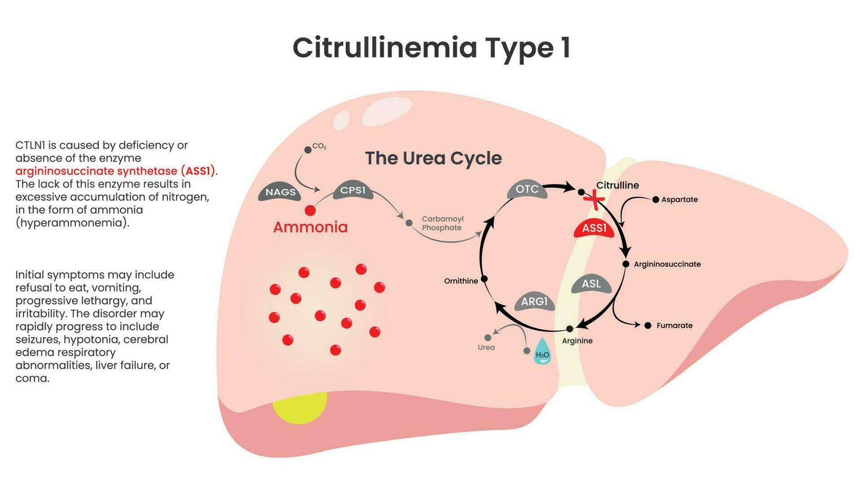 vector informativo de deficiencia de citrulinemia tipo 1 ass1