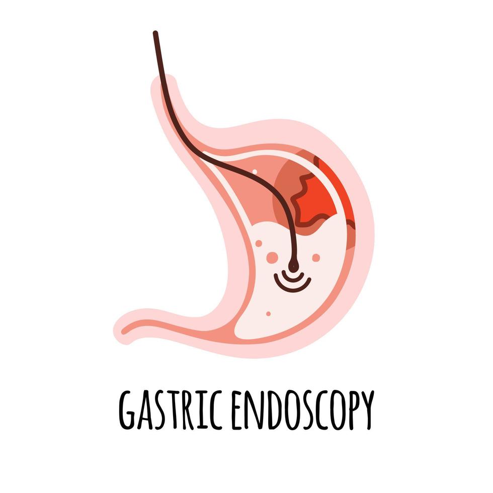 Endoscopy. The stomach of a person with an ulcer. Gastroenterology. Vector illustration in a flat style.