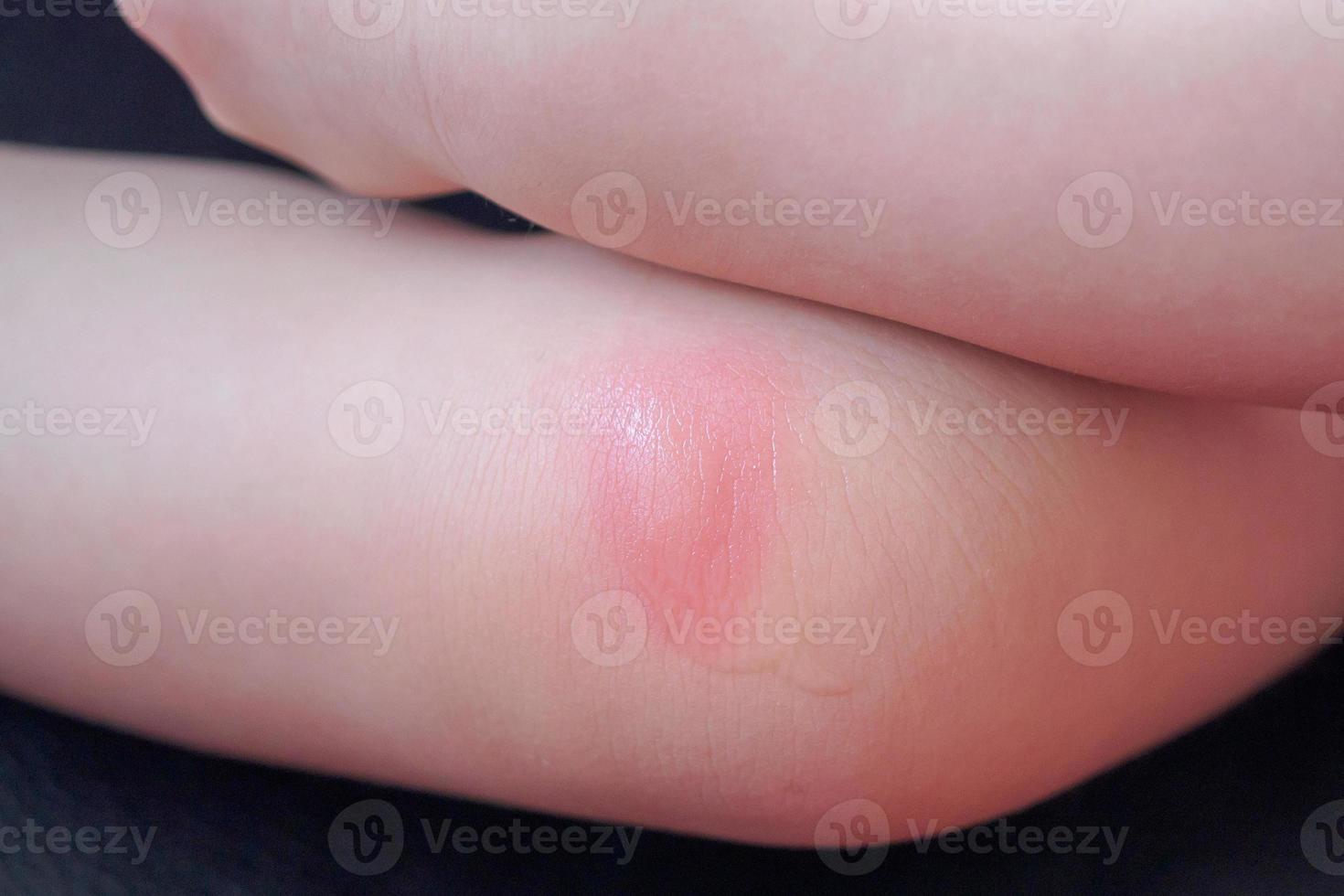 Erupción en la piel del bebé y alergia con mancha roja causada por picadura de mosquito en la rodilla foto