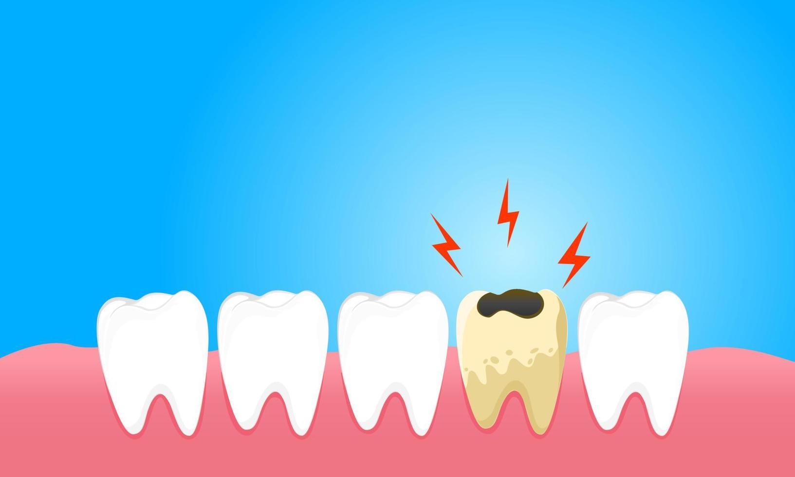 Las caries causan dolor de encías y sensibilidad dental. vector