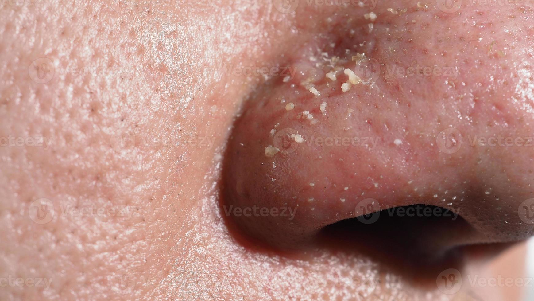 Acne and problem pores. White and blackhead pimples from nose pores. photo