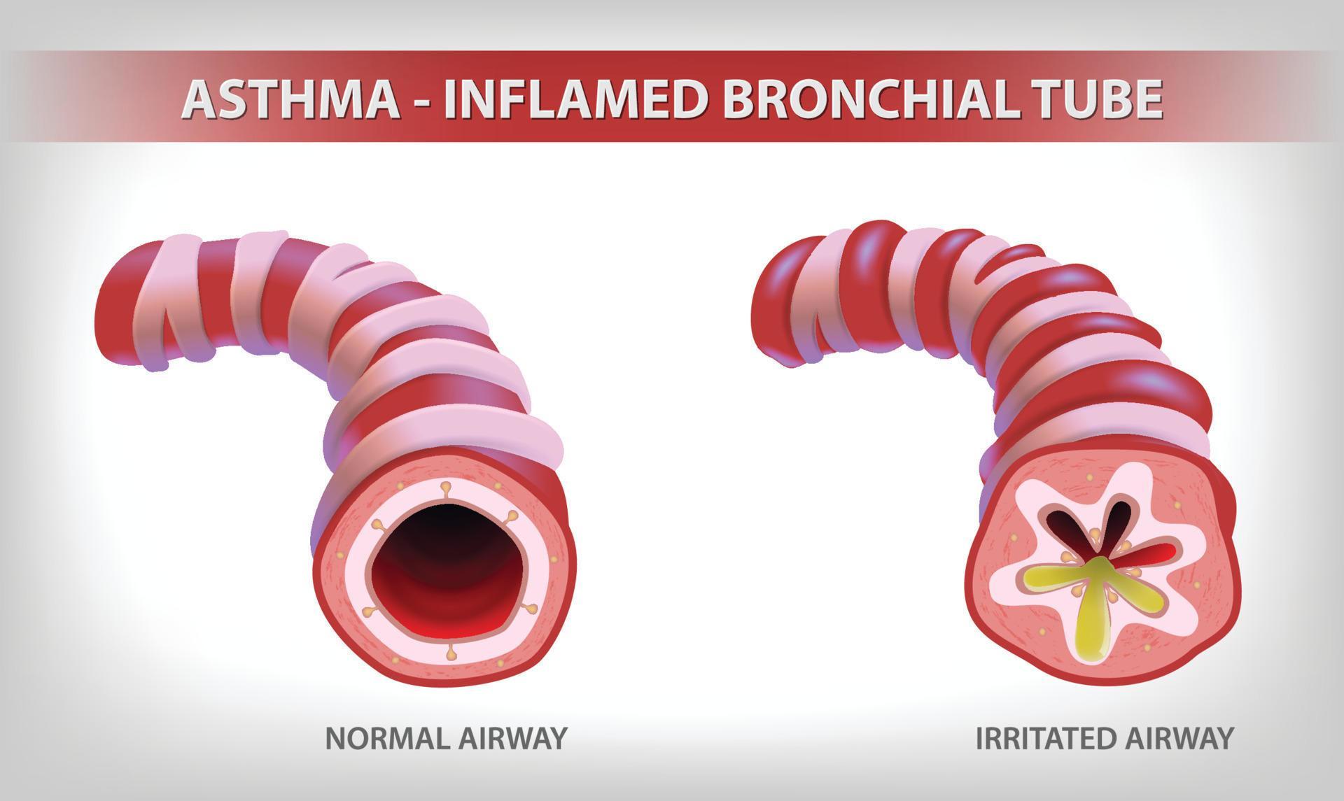The illustration shows two parts of the bronchi, one normal and the