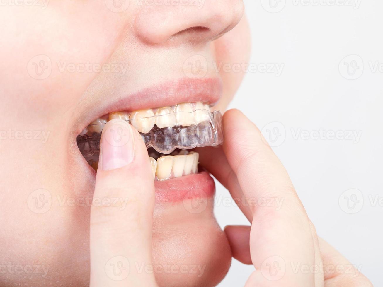 young woman puts transparent aligner photo