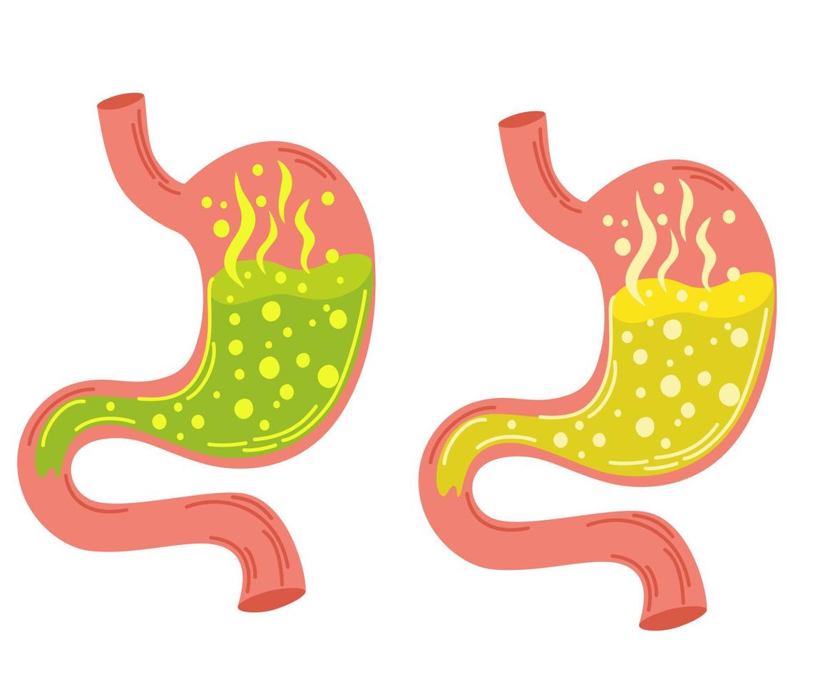 Human stomach set. Gastritis and acid reflux, indigestion, vomiting, heartburn and stomach pain problems. Unhealthy stomach concept. Heartburn, illness, discomfort, pain. Flat vector illustration