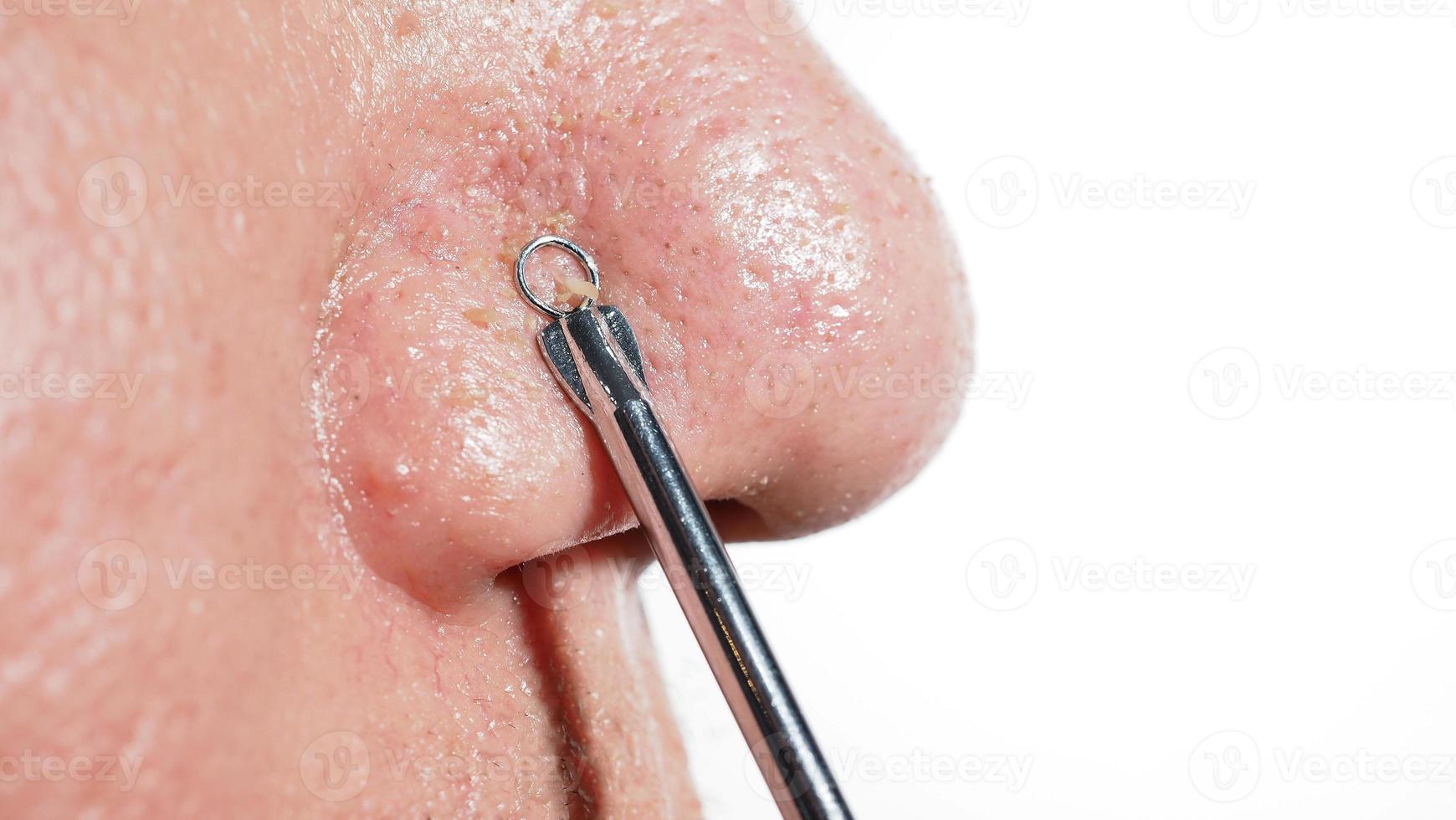 Acne and problem pores. White and blackhead pimples from nose pores. photo
