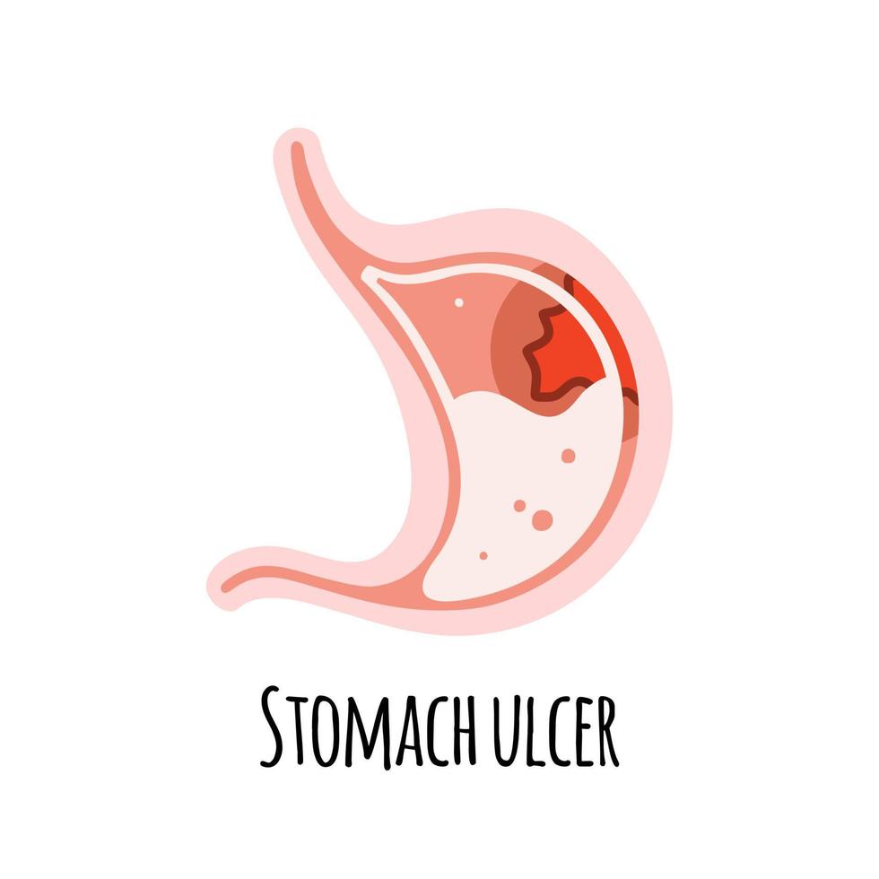 The stomach of a person with an ulcer. Gastroenterology. Vector illustration in a flat style.