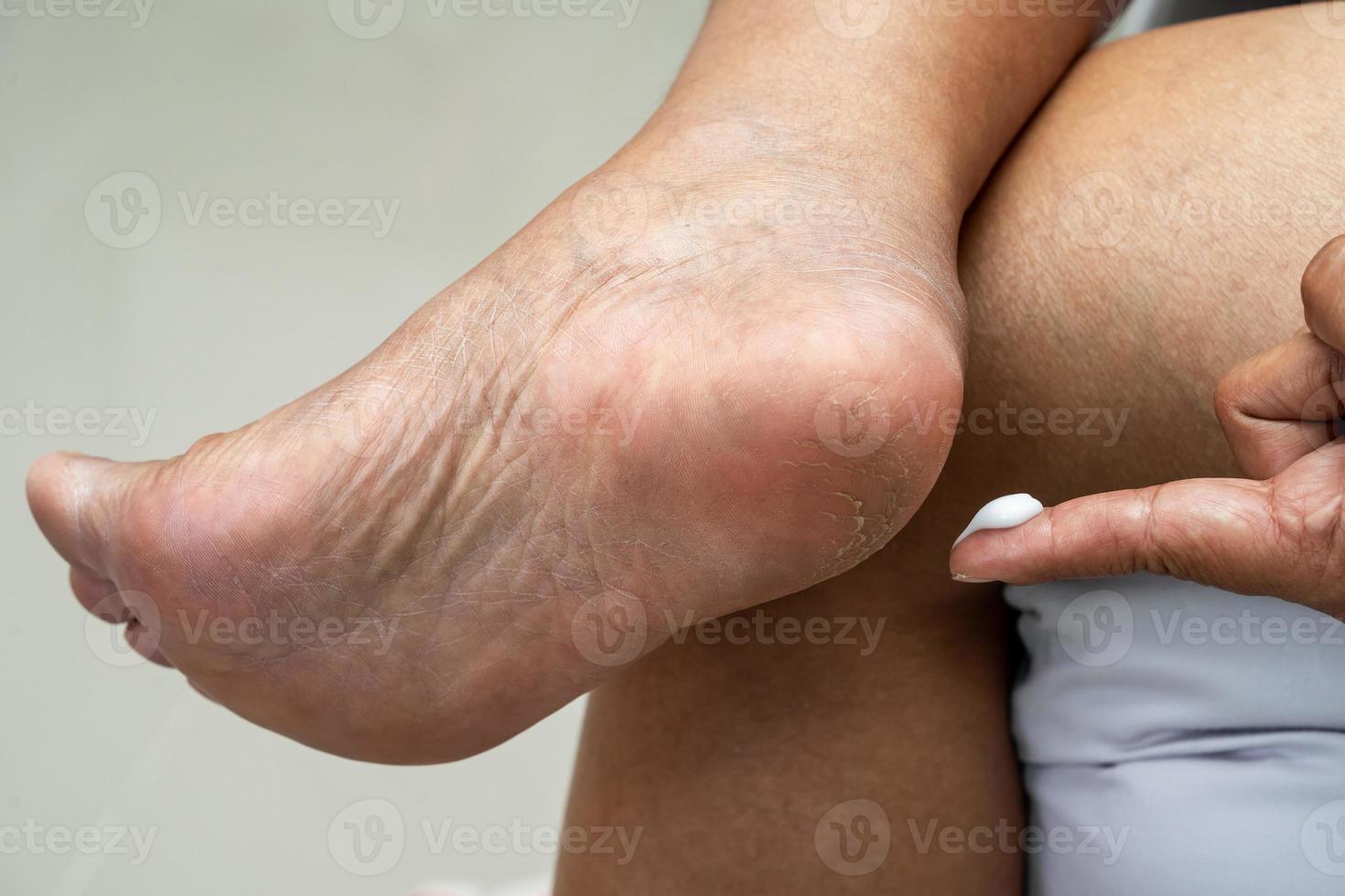 Woman care feet with cracked and dry heel skin cream at home. photo