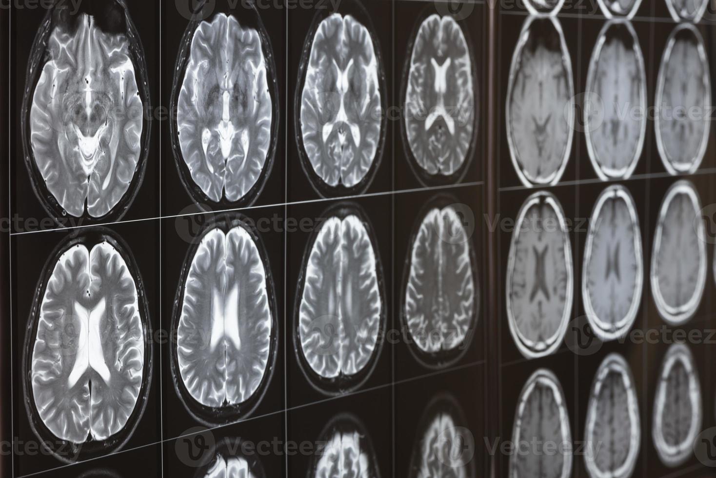 imágenes de resonancia magnética cerebral en la caja de luz foto