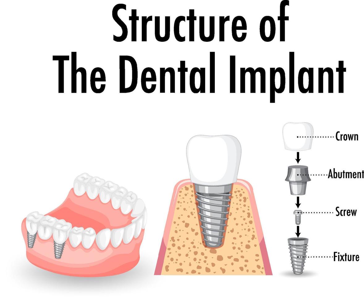 Infographic of human in structure of the dental implant vector