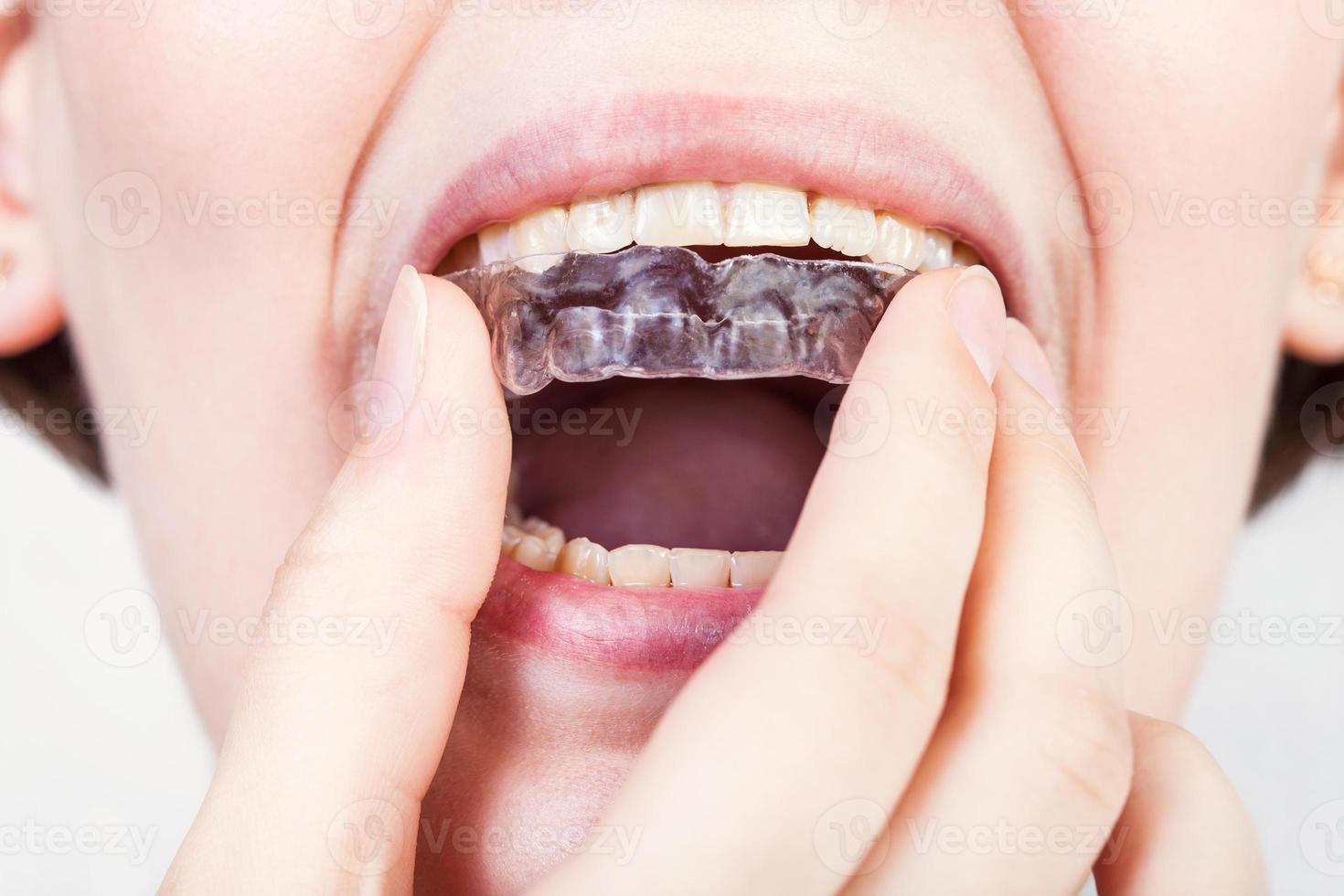 direct view of young woman fixing clear aligner photo