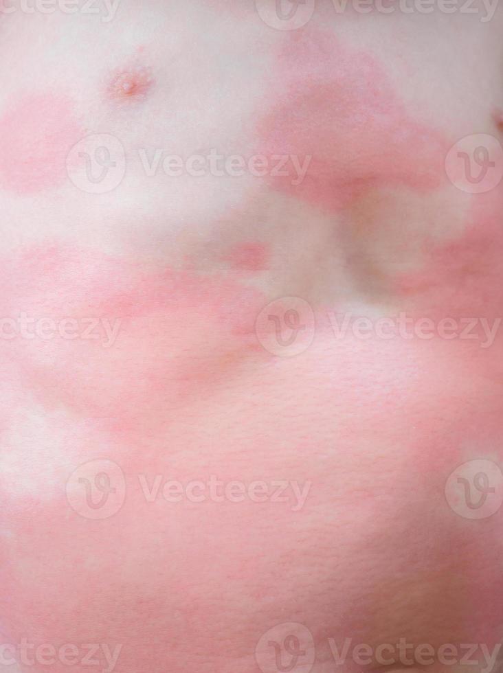 Severe eczema skin rash and allergic reaction symtom at little asian child body cause by hypersensitivity photo