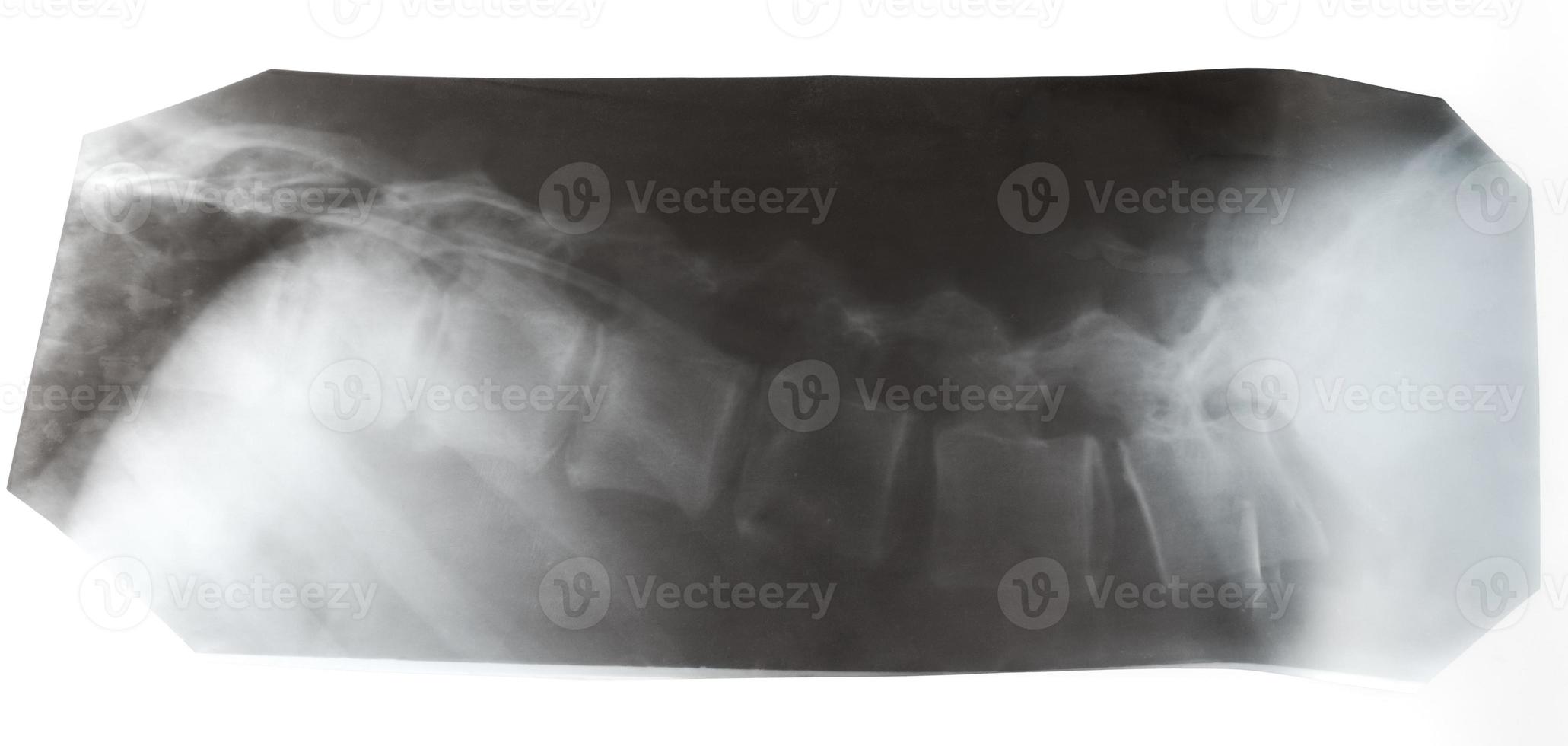 X-ray picture of human vertebral column isolated photo