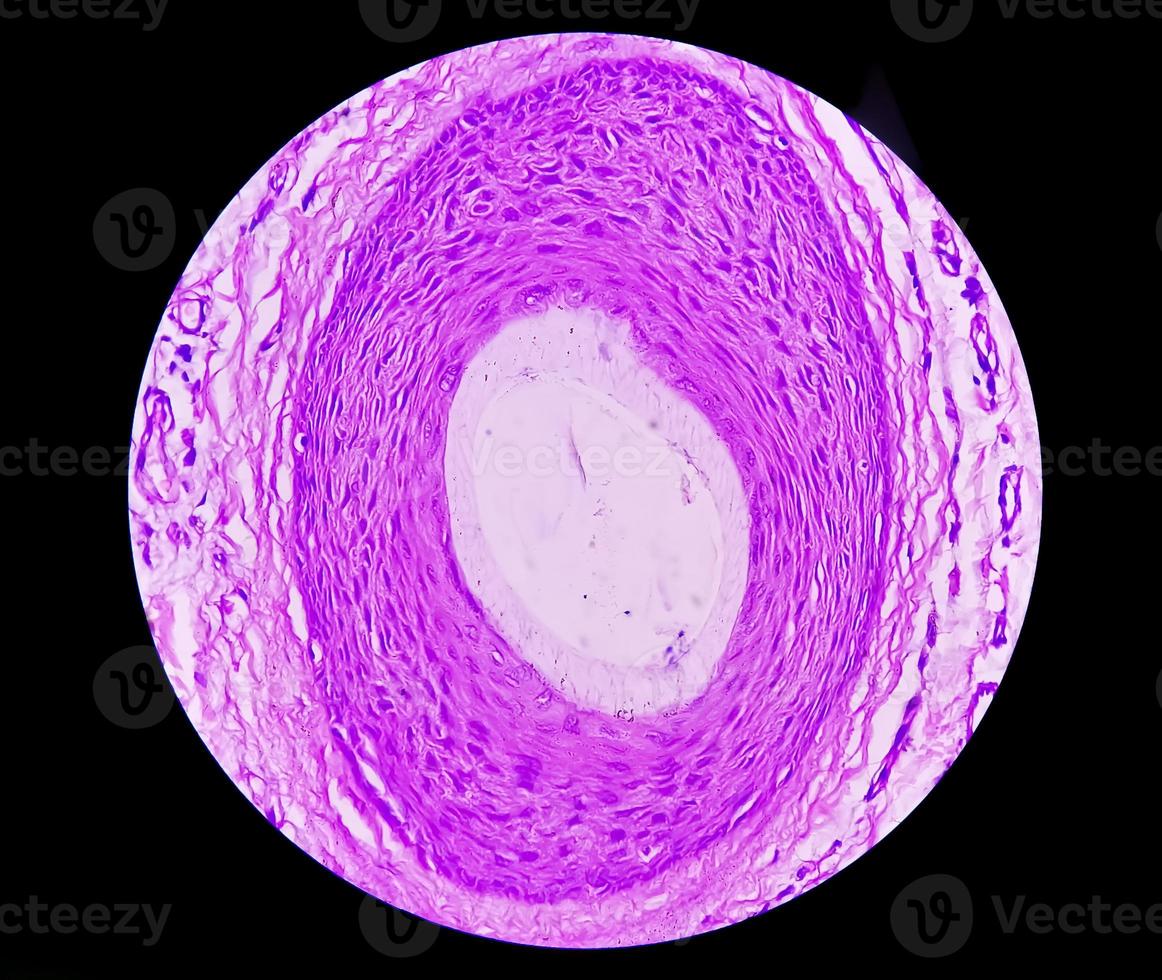 Histological biopsy of Scrotal wall under microscopy showing Calcinosis cutis. Scrotal calcinosis. Calcinosis cutis of scrotum photo