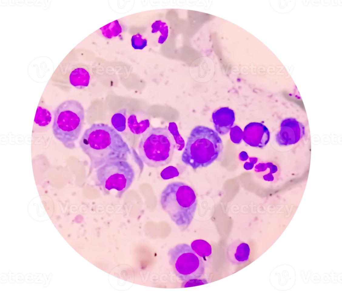 Microscopic view of bone marrow slide feature are suggestive Multiple myeloma, also known as myeloma, is a type of bone marrow cancer. photo